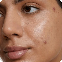 Acne & Blemishes