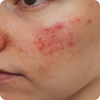 Redness and Irritation