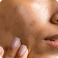 Uneven Skin Tone
