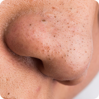 Clogged Pores & Blackheads