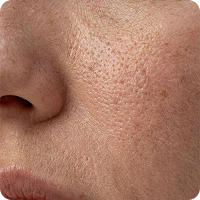 Enlarged Pores