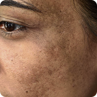 Melasma